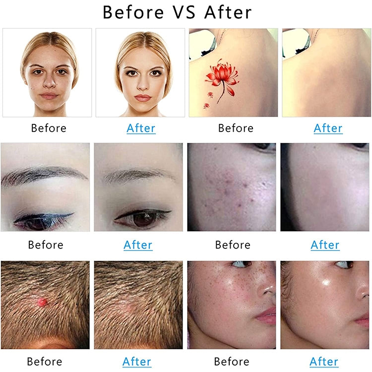 AA-A401 Small Freckle and Mole Removal Pen Tattoo and Eyebrow Removal Beauty Instrument, Color: Blu-ray Battery by buy2fix